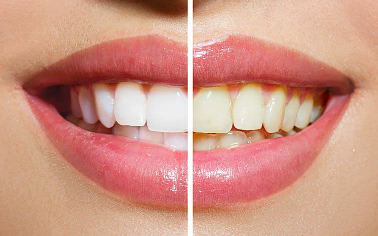 A satisfied patient with a radiant, white smile, symbolizing the confidence boost from effective teeth whitening Burnley