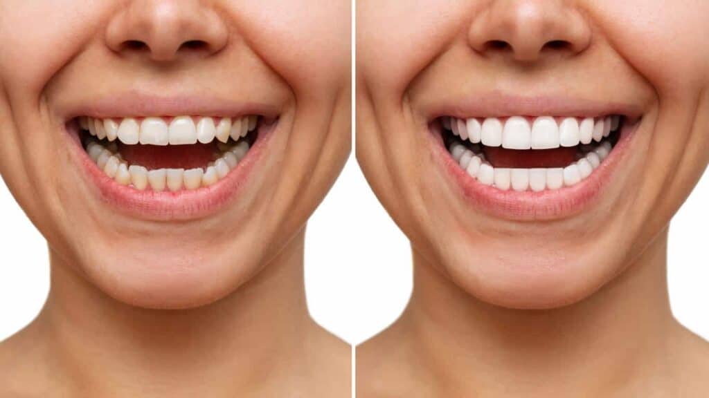 Contact Aspire White for teeth whitening services – Get in touch with Burnley today