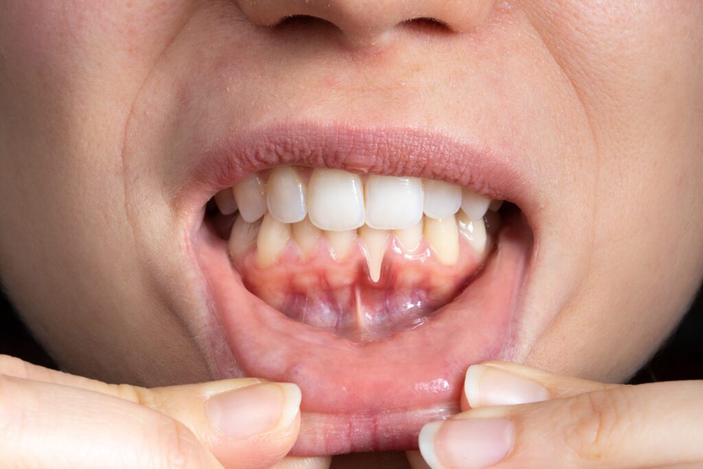 Preparing for teeth whitening with receding gums Burnley