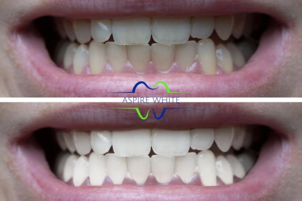 1 hour laser teeth whitening before and after results Burnley
