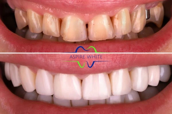 Yellow teeth results - 1 hour whitening before and after results Burnley