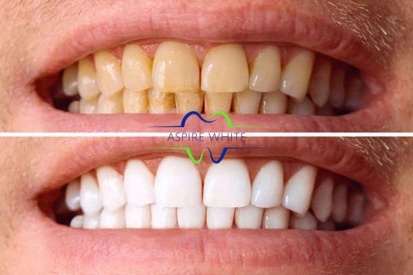 Get noticeable whiter smile in just one hour! Book your teeth whitening treatment Burnley today!