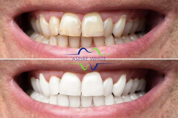 Achieve a radiant smile with professional laser teeth whitening Burnley